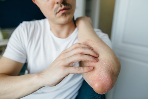 Symptoms of Dust Mite Eczema Exposure