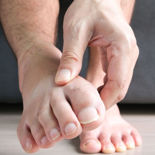 Treating and Preventing Gout Flare-Ups