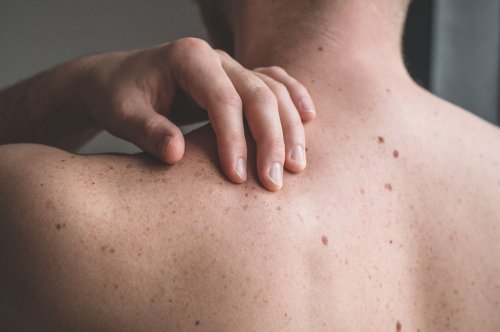More Than Half of Melanoma Diagnoses in the U.S. Are Unnecessary, Study Finds