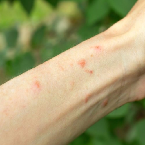 How to Tell the Difference Between Shingles & Poison Ivy | Flipboard
