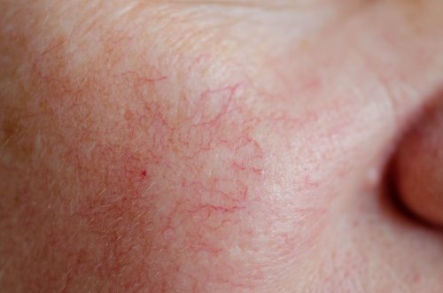 What Causes Broken Blood Vessels on the Face?