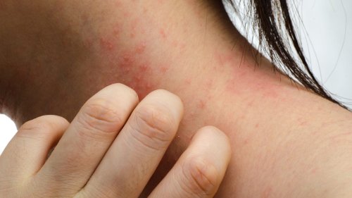 What Is Hyperkeratosis?
