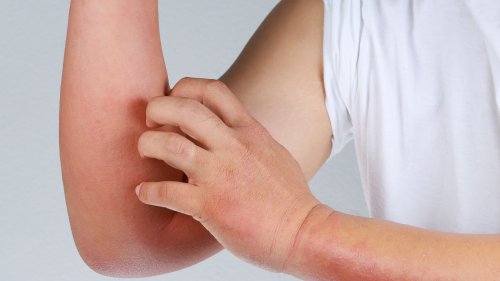 How to Identify & Treat an Itchy Kidney Disease Rash