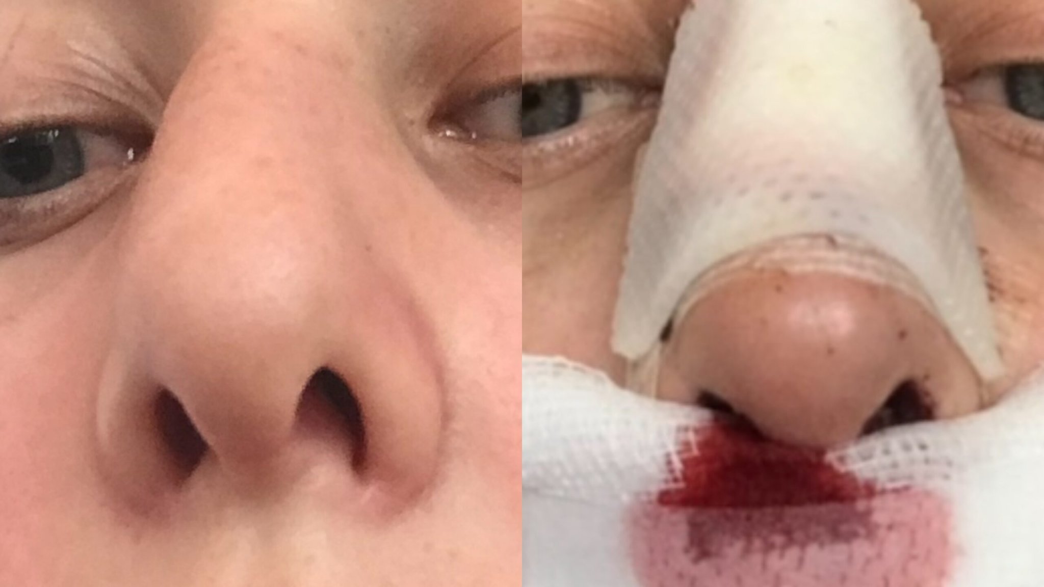 I Spent $17,000 on a Nose Job and It Didn’t Change a Thing