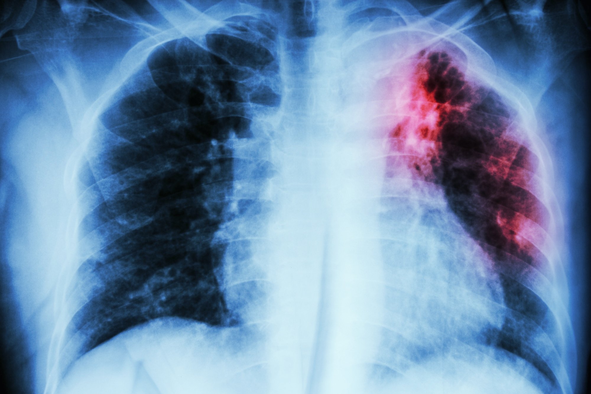 There's a Massive Tuberculosis Outbreak in the US