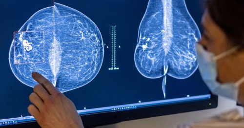 Google partners with med tech company to develop AI breast cancer screening tools