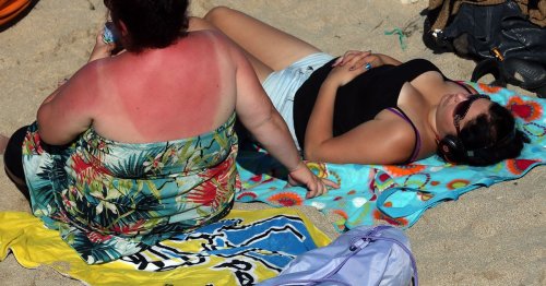 The best ways to deal with sunburn as heatwave arrives in North Wales