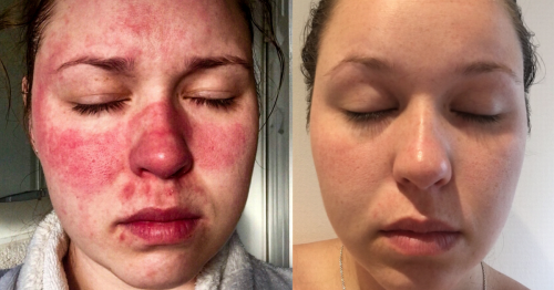 Mum-to-be who found it hard to look in mirror due to skin condition discovers £20 cure