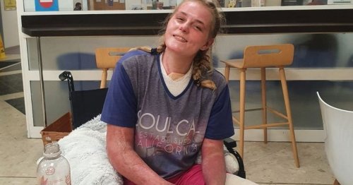Woman left in coma with burns to more than half her body after bonfire explodes