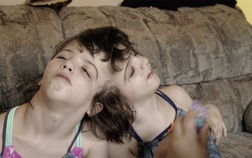How Conjoined Twins Are Making Scientists Question the Concept of Self | The Walrus