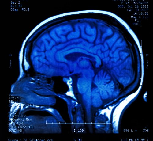 New brain science shows poor kids have smaller brains than affluent kids