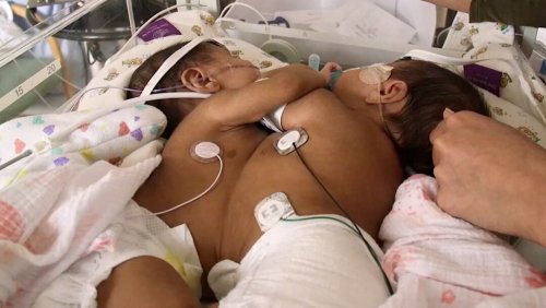 How virtual reality helped separate conjoined twins