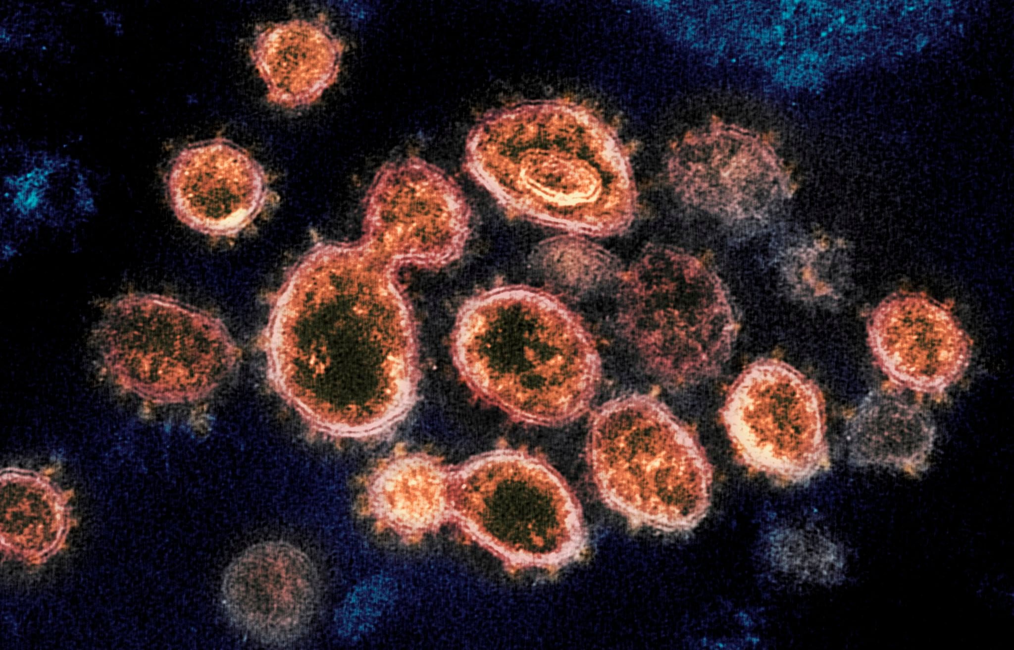 Scientists pinpoint genes common among people with severe coronavirus infections