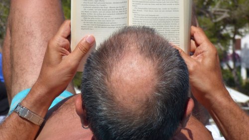Über 50 Prozent der Männer betroffen – das hilft gegen erblich bedingten Haarausfall