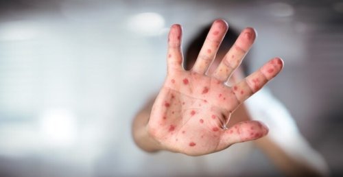 Poll: Belief in false measles claims correlated with lower vaccination rates