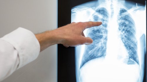 Tuberkulose in Bonn: Was macht diese Krankheit so tückisch?