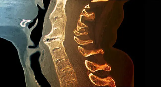ANKYLOSING SPONDYLITIS 
AND
PAIN MANAGEMENT - cover