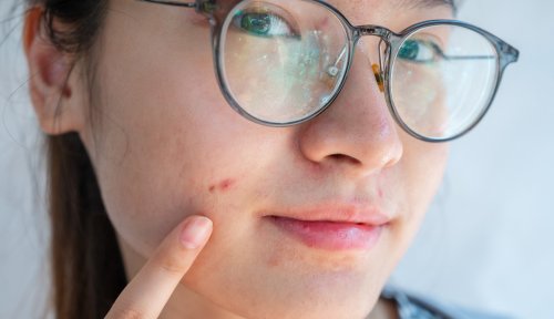 5 Dermatologists Share Their Best-Kept Secrets for Fighting Acne—And We Promise, You Haven’t Heard These Before
