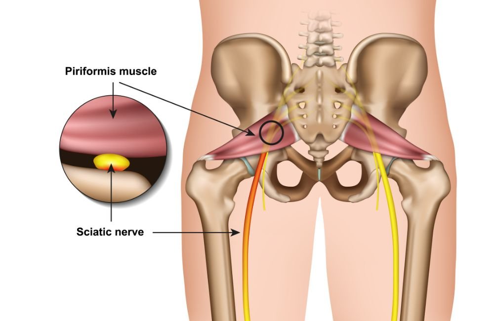 Suffering From Sciatica? These Are the 5 Best Exercises for Immediate Pain Relief