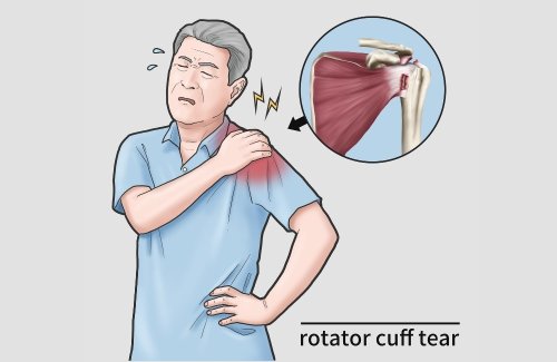 Rotator Cuff Injuries Can Be Devastating, Here Are 5 Best Exercises To Keep Your Shoulders Healthy