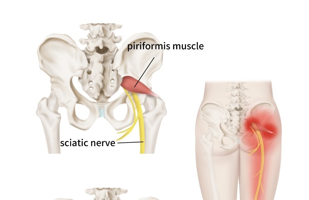 How To Get A Deep Piriformis Stretch To Get Rid Of Sciatica, Hip & Lower Back Pain