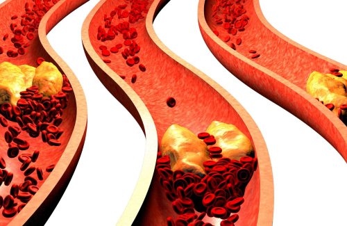 15 Foods That’ll Lower Cholesterol + 5 Worst Foods That’ll Clog Your Arteries