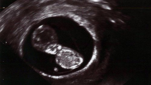Zahl der Schwangerschaftsabbrüche steigt – fast zehn Prozent mehr als im Vorjahr