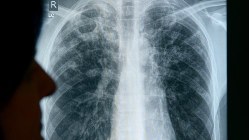 27 Ländern droht Kollaps im Kampf gegen Tuberkulose