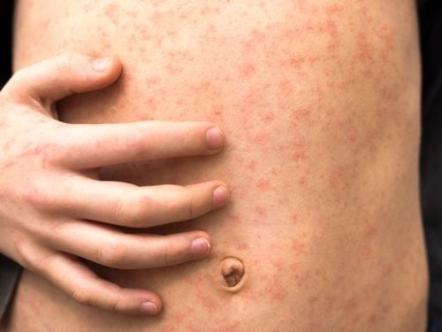 ‘Out-of-town visitor’ tests positive for measles in Cincinnati