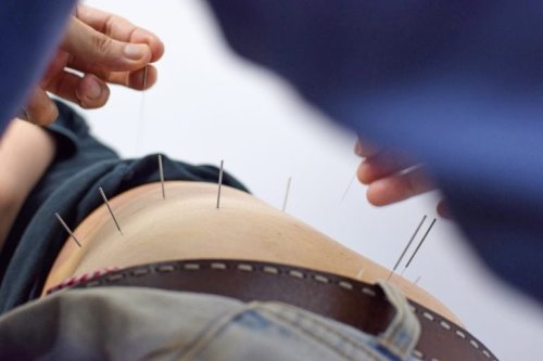 Delaware, other state Medicaid programs consider acupuncture as opioid alternative