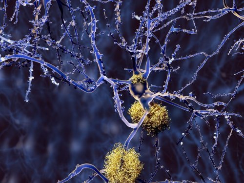 Philly Alzheimer’s disease researchers call a new diagnostic blood test promising, but advise caution
