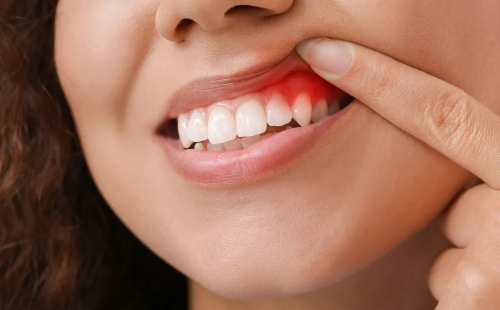 Groundbreaking topical gel treats and prevents gum disease at home