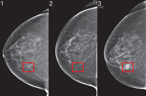 Deep-learning AI system revolutionizes breast cancer treatment