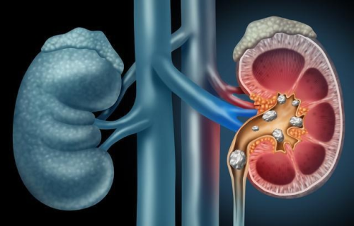 Cutting-edge medical treatment eliminates kidney stones with little to no pain