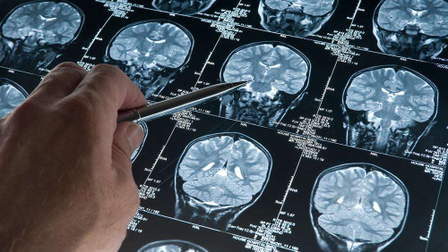Study identifies why Alzheimer’s disease only damages certain parts of the brain