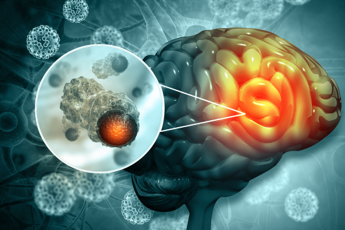 Groundbreaking study points to an effective cure for brain cancer