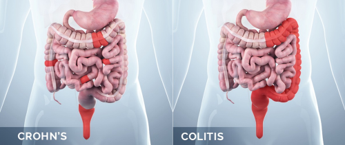 Groundbreaking treatment uses viruses to fight Crohn’s and ulcerative colitis
