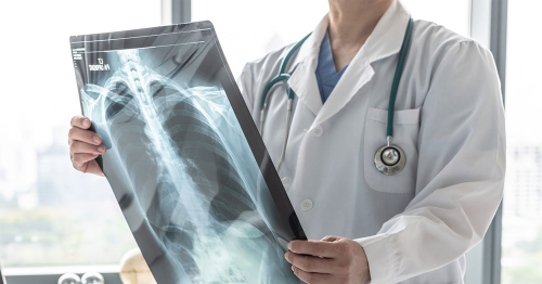 Zinc reverses lung damage and significantly improves patient survival