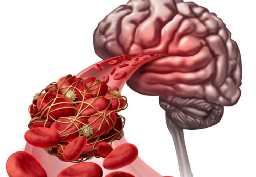 Missing link between Alzheimer's and vascular disease found?