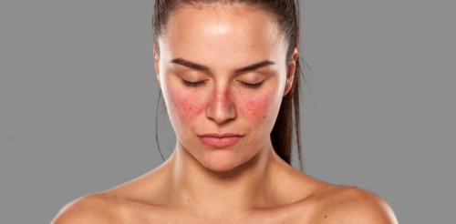 Researchers discover the genetic cause of lupus