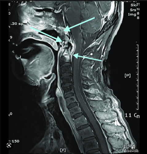 Craniocervical Instability & Ehlers-Danlos Syndrome