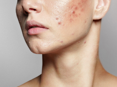 Researchers achieve significant breakthrough in the treatment of acne