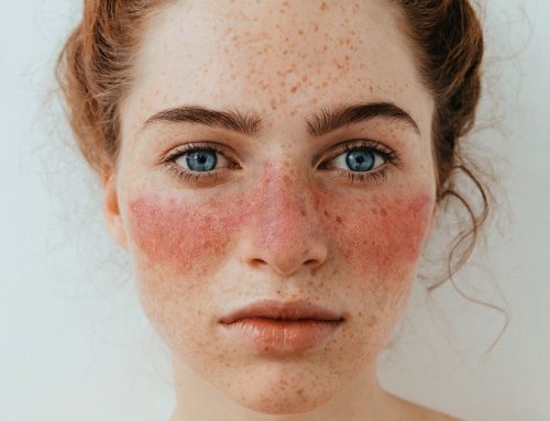 Scientists finally discover the cause of lupus