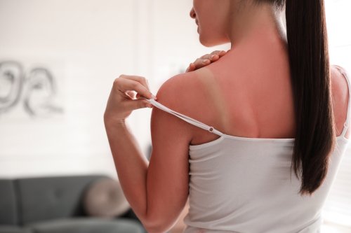 Bei Sonnenbrand: Diese beliebten Produkte solltest du nicht verwenden