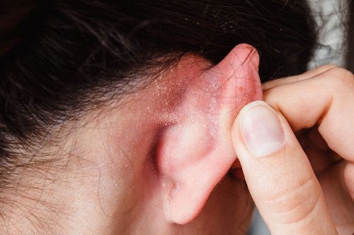 Friseure schuld? Hochansteckender Hautpilz auf Kopfhaut breitet sich aus