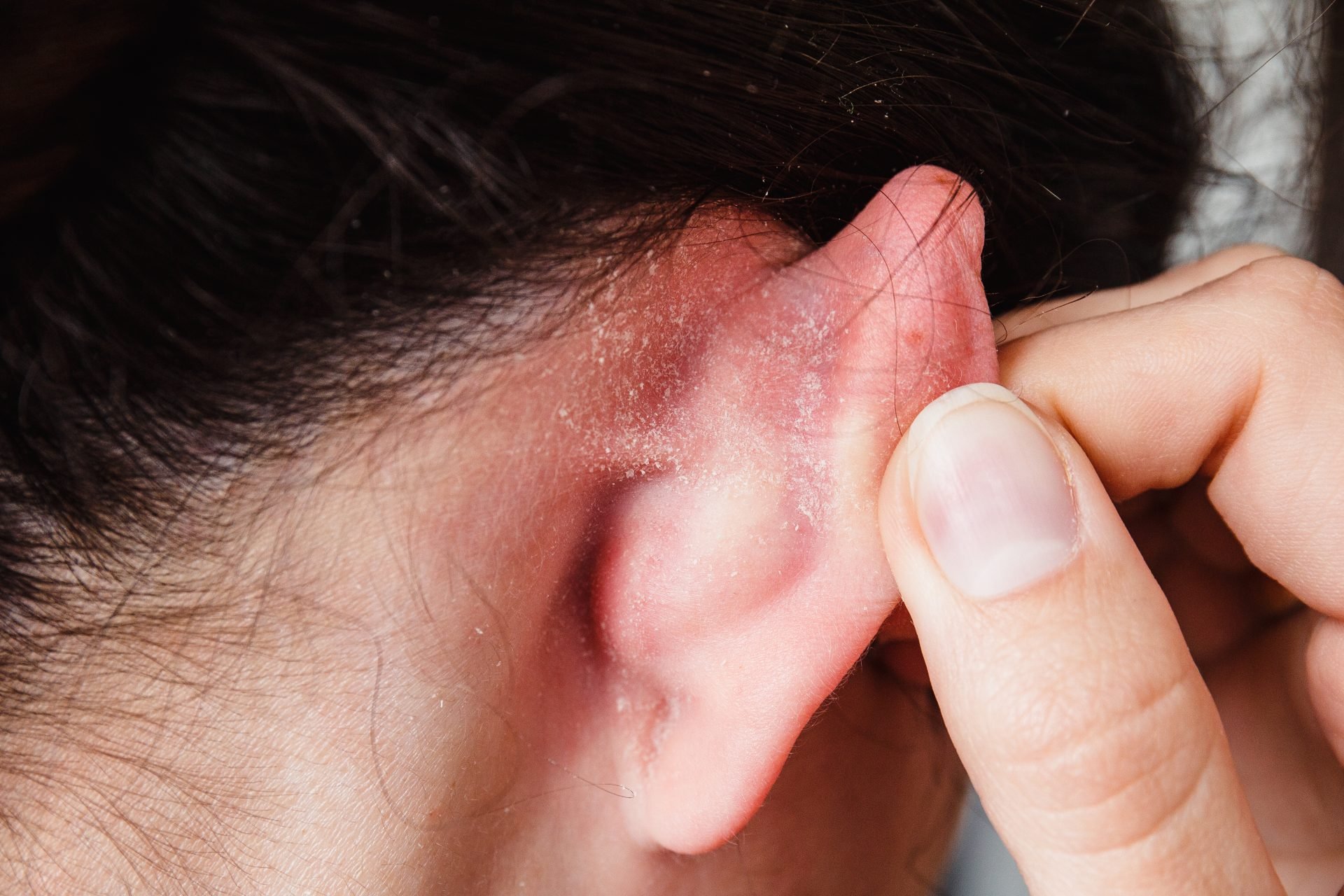 Friseure schuld? Hochansteckender Hautpilz auf Kopfhaut breitet sich aus