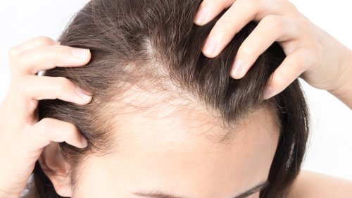 Medical Mystery: Hair Thinning, Chronic Pain, and Inflammation — What Caused This TikToker’s Symptoms?