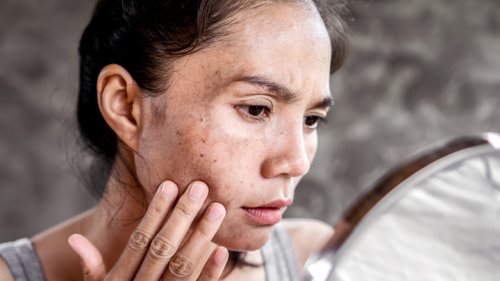 An Expert's Guide To Banishing Dark Spots