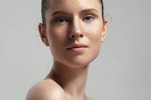 Hyperpigmentation - cover