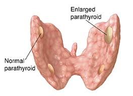 What is Primary Hyperparathyroidism?